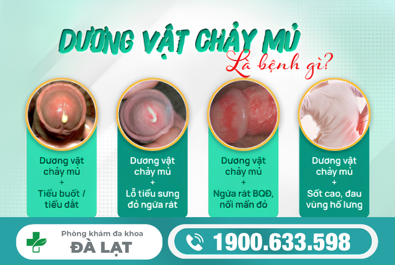 Chảy mủ lỗ sáo có nguy hiểm không ?